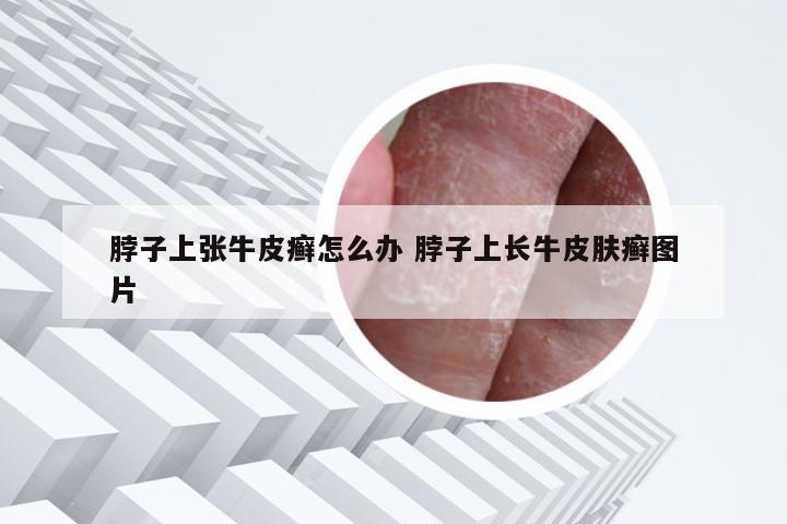脖子上张牛皮癣怎么办 脖子上长牛皮肤癣图片