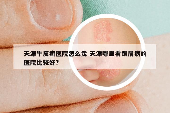 天津牛皮癣医院怎么走 天津哪里看银屑病的医院比较好?