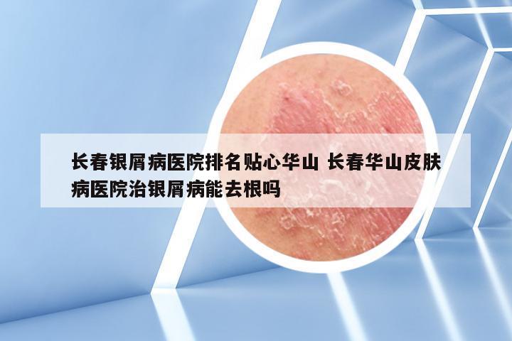 长春银屑病医院排名贴心华山 长春华山皮肤病医院治银屑病能去根吗