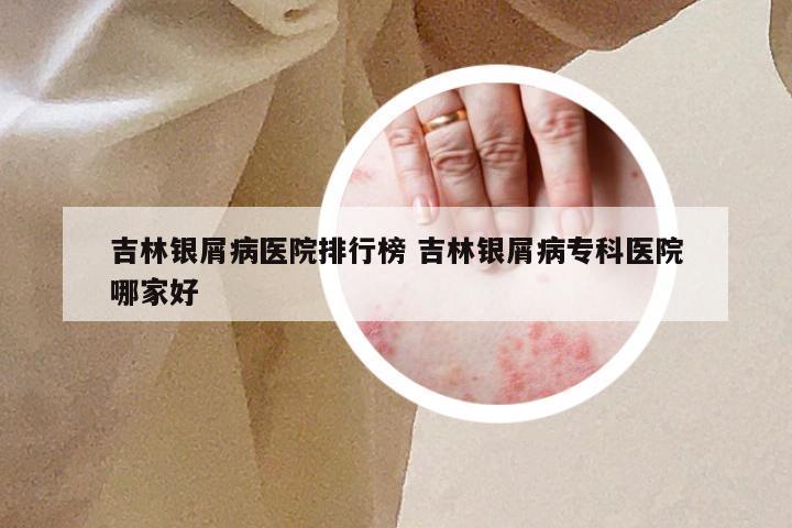 吉林银屑病医院排行榜 吉林银屑病专科医院哪家好