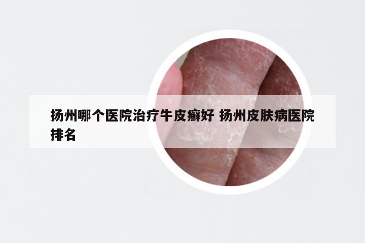 扬州哪个医院治疗牛皮癣好 扬州皮肤病医院排名