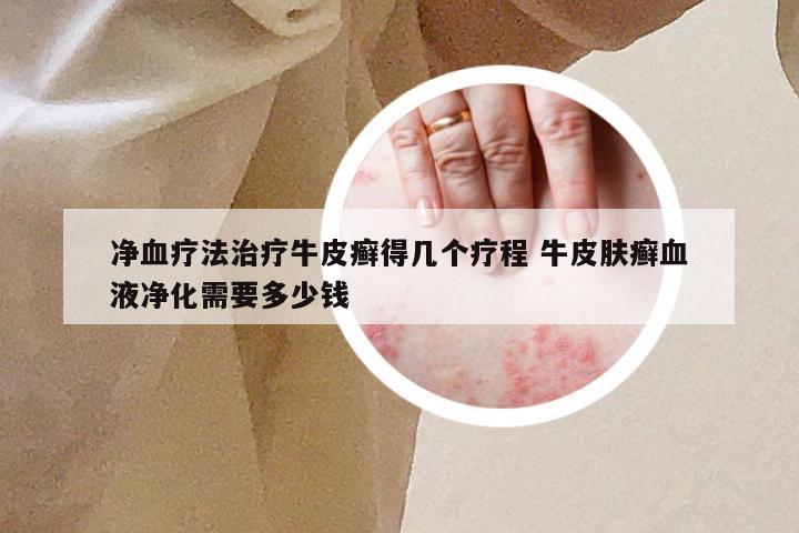 净血疗法治疗牛皮癣得几个疗程 牛皮肤癣血液净化需要多少钱