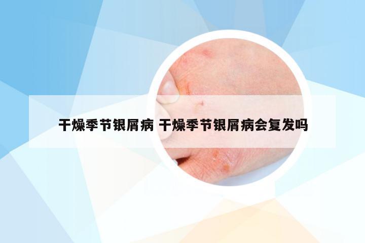 干燥季节银屑病 干燥季节银屑病会复发吗