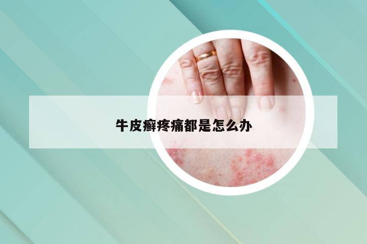 牛皮癣疼痛都是怎么办