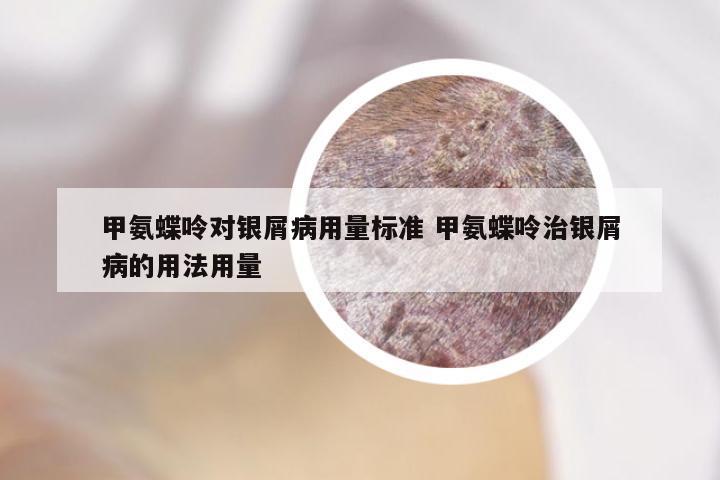 甲氨蝶呤对银屑病用量标准 甲氨蝶呤治银屑病的用法用量