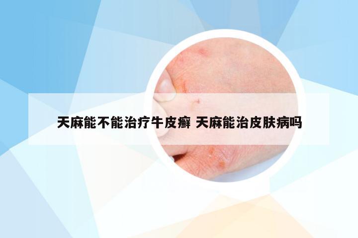 天麻能不能治疗牛皮癣 天麻能治皮肤病吗