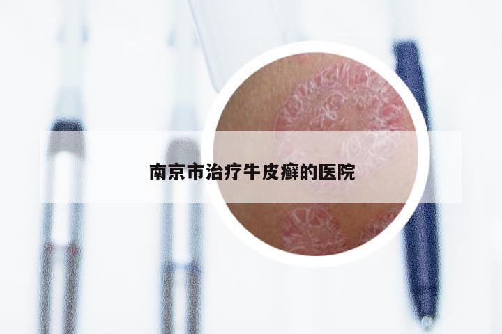 南京市治疗牛皮癣的医院