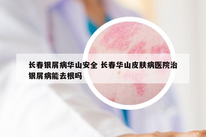 长春银屑病华山安全 长春华山皮肤病医院治银屑病能去根吗