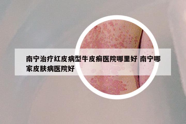 南宁治疗红皮病型牛皮癣医院哪里好 南宁哪家皮肤病医院好