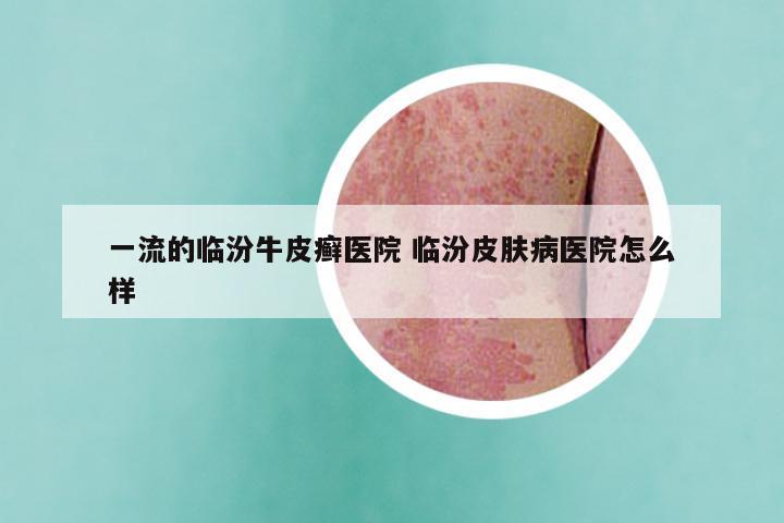 一流的临汾牛皮癣医院 临汾皮肤病医院怎么样