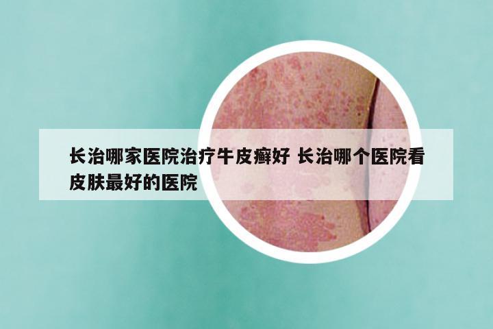 长治哪家医院治疗牛皮癣好 长治哪个医院看皮肤最好的医院