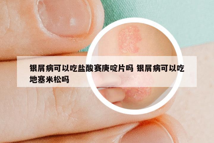 银屑病可以吃盐酸赛庚啶片吗 银屑病可以吃地塞米松吗