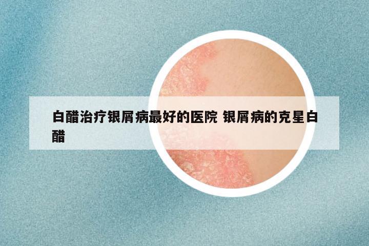 白醋治疗银屑病最好的医院 银屑病的克星白醋