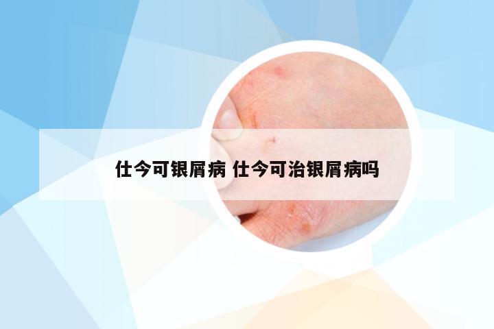 仕今可银屑病 仕今可治银屑病吗