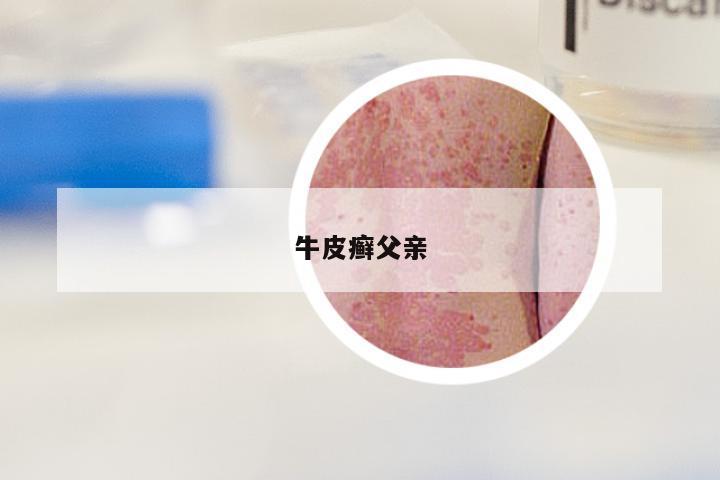 牛皮癣父亲