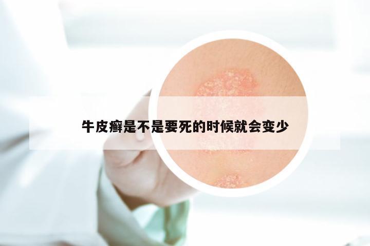 牛皮癣是不是要死的时候就会变少
