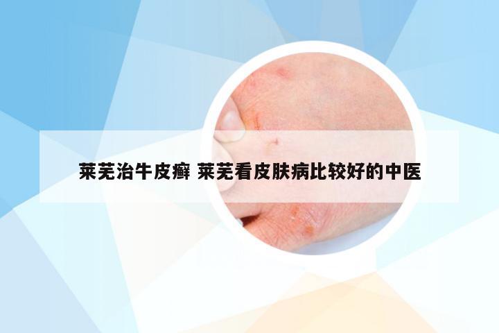 莱芜治牛皮癣 莱芜看皮肤病比较好的中医