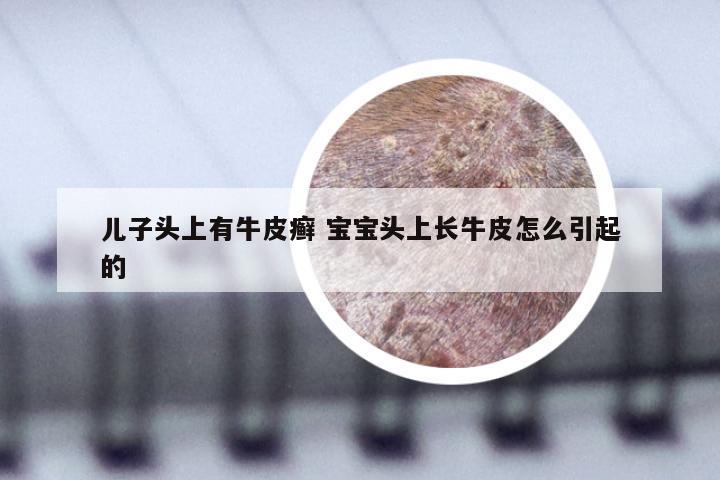 儿子头上有牛皮癣 宝宝头上长牛皮怎么引起的