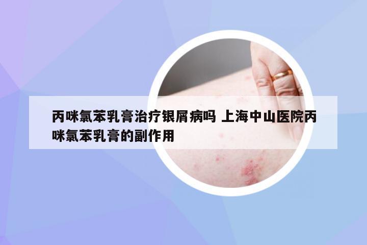 丙咪氯苯乳膏治疗银屑病吗 上海中山医院丙咪氯苯乳膏的副作用