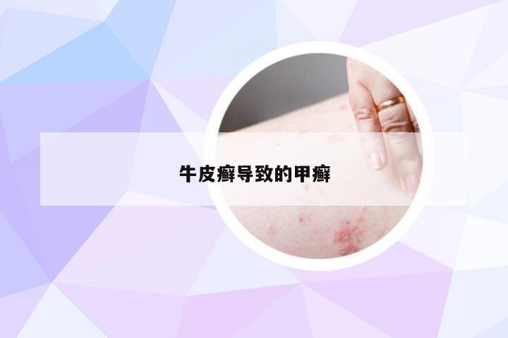 牛皮癣导致的甲癣