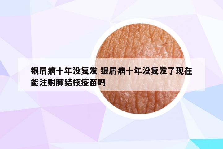 银屑病十年没复发 银屑病十年没复发了现在能注射肺结核疫苗吗