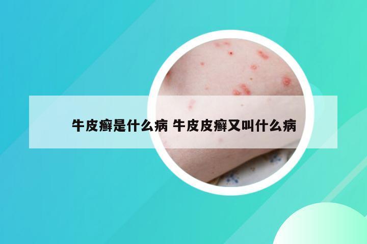 牛皮癣是什么病 牛皮皮癣又叫什么病