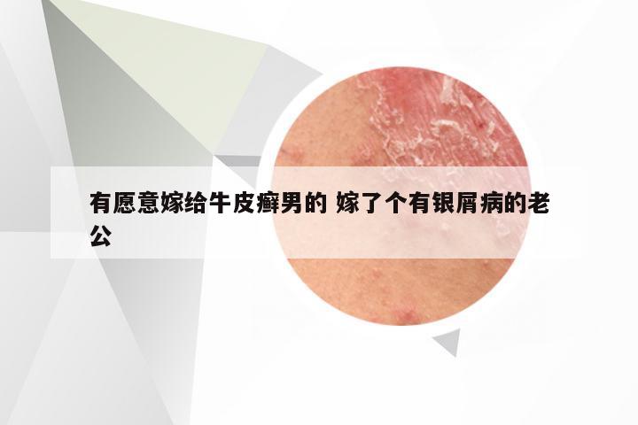 有愿意嫁给牛皮癣男的 嫁了个有银屑病的老公