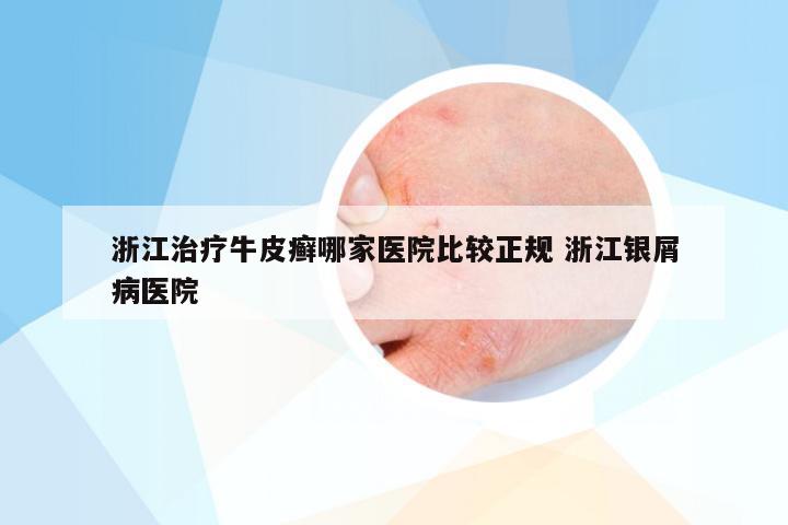 浙江治疗牛皮癣哪家医院比较正规 浙江银屑病医院