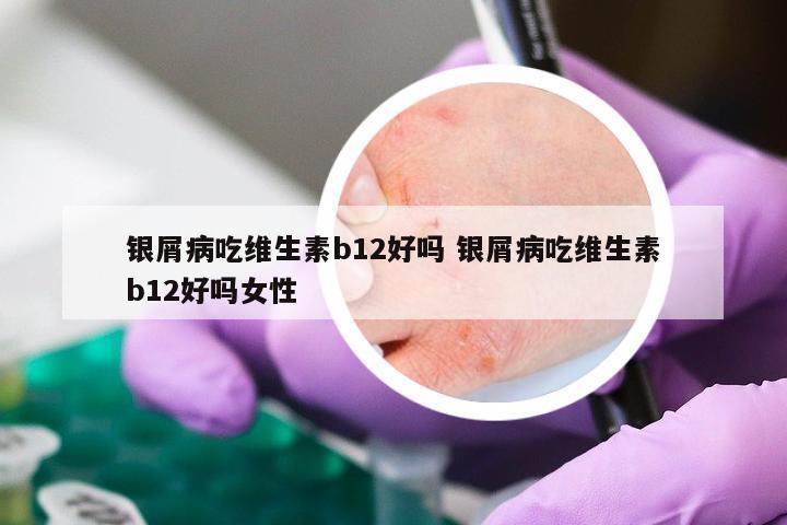 银屑病吃维生素b12好吗 银屑病吃维生素b12好吗女性