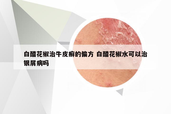 白醋花椒治牛皮癣的偏方 白醋花椒水可以治银屑病吗