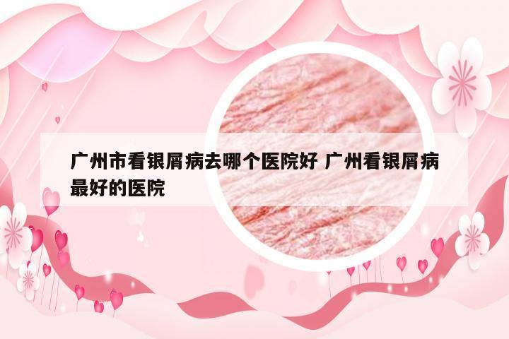 广州市看银屑病去哪个医院好 广州看银屑病最好的医院