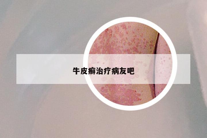 牛皮癣治疗病友吧