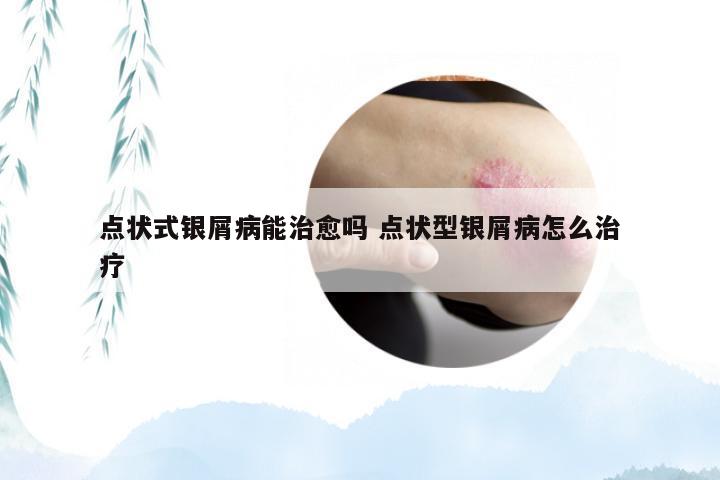 点状式银屑病能治愈吗 点状型银屑病怎么治疗