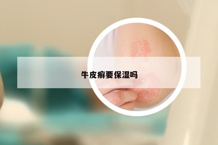牛皮癣要保湿吗