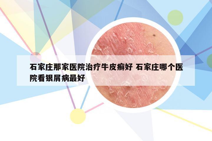 石家庄那家医院治疗牛皮癣好 石家庄哪个医院看银屑病最好