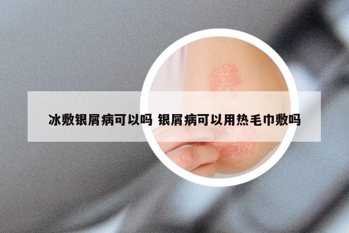 冰敷银屑病可以吗 银屑病可以用热毛巾敷吗