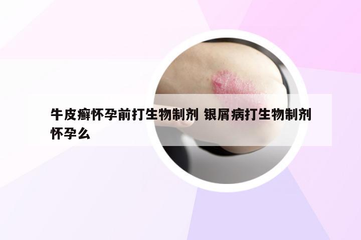 牛皮癣怀孕前打生物制剂 银屑病打生物制剂怀孕么
