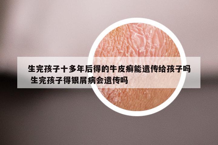 生完孩子十多年后得的牛皮癣能遗传给孩子吗 生完孩子得银屑病会遗传吗