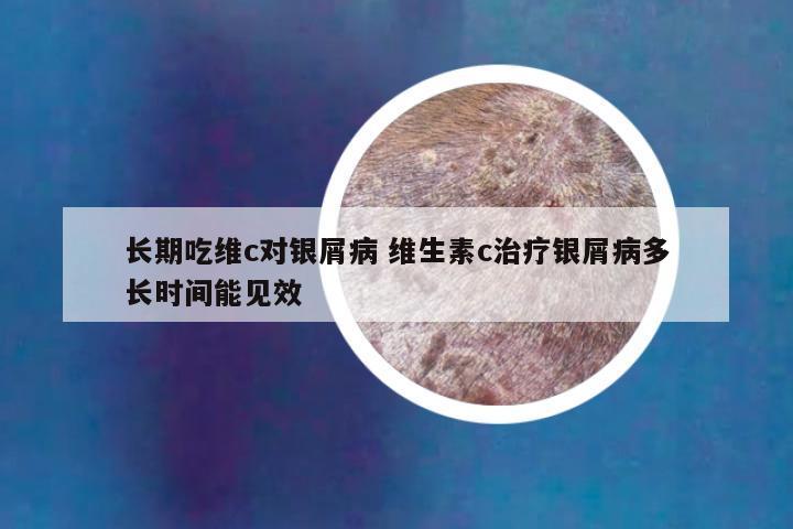 长期吃维c对银屑病 维生素c治疗银屑病多长时间能见效