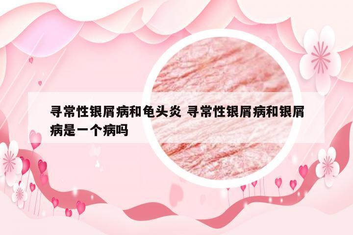 寻常性银屑病和龟头炎 寻常性银屑病和银屑病是一个病吗