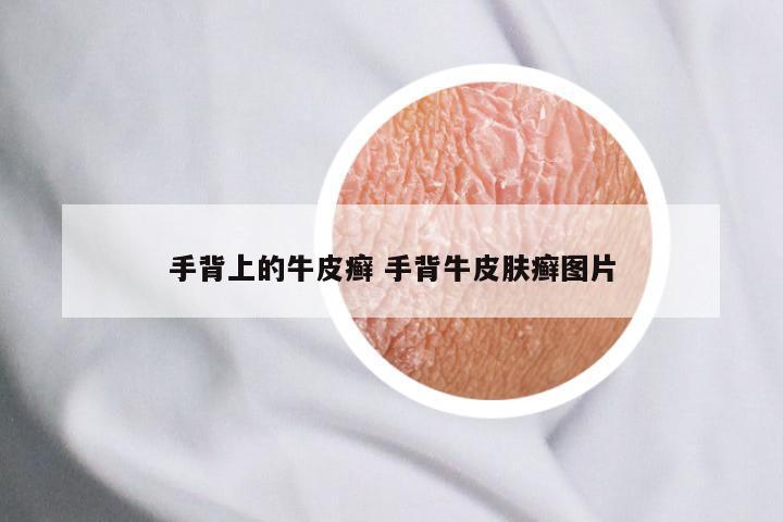 手背上的牛皮癣 手背牛皮肤癣图片