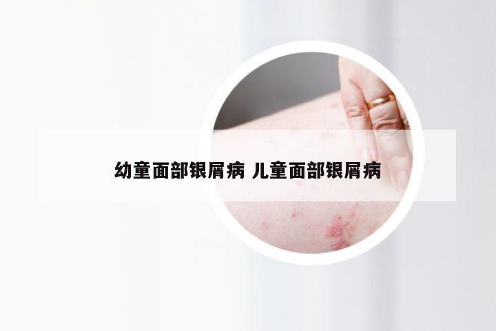 幼童面部银屑病 儿童面部银屑病