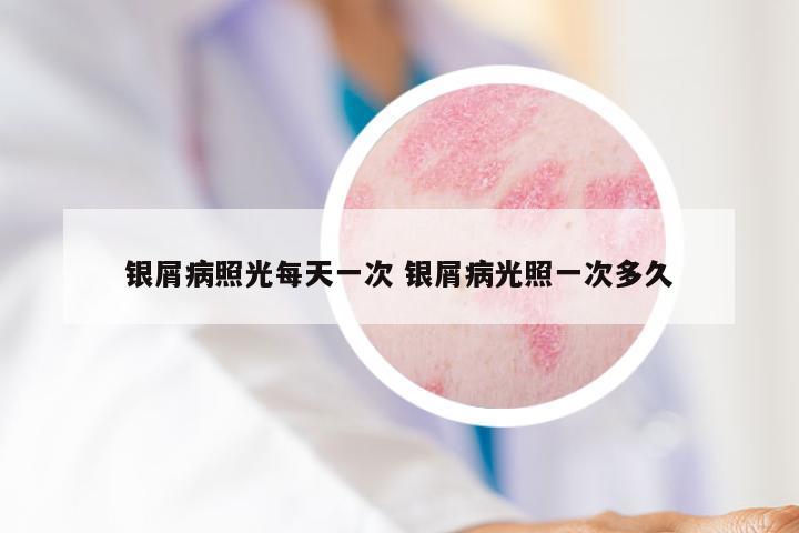 银屑病照光每天一次 银屑病光照一次多久