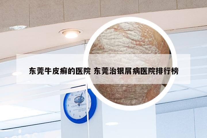 东莞牛皮癣的医院 东莞治银屑病医院排行榜