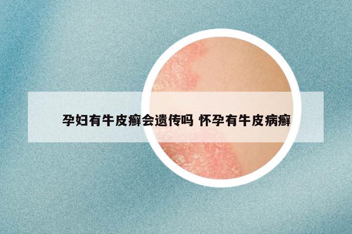 孕妇有牛皮癣会遗传吗 怀孕有牛皮病癣