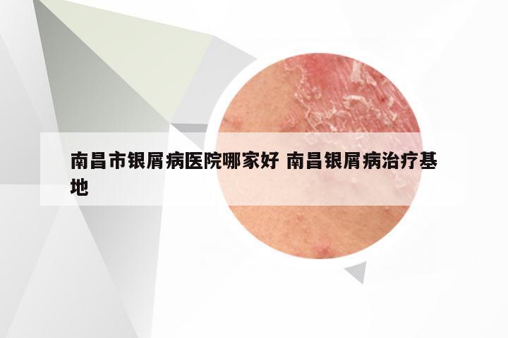 南昌市银屑病医院哪家好 南昌银屑病治疗基地
