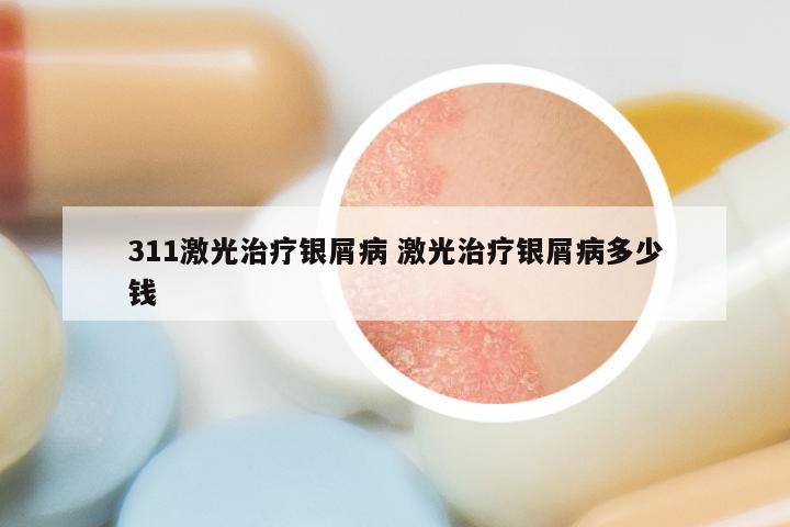 311激光治疗银屑病 激光治疗银屑病多少钱