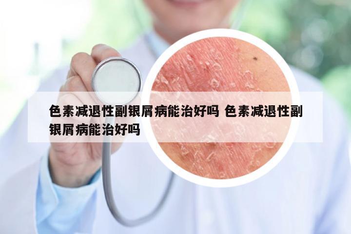 色素减退性副银屑病能治好吗 色素减退性副银屑病能治好吗