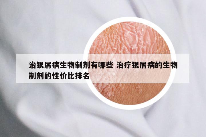 治银屑病生物制剂有哪些 治疗银屑病的生物制剂的性价比排名