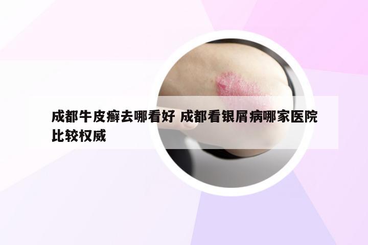 成都牛皮癣去哪看好 成都看银屑病哪家医院比较权威